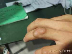 腱鞘囊肿的治疗方法(手腕腱鞘囊肿怎么根治)-华海博客