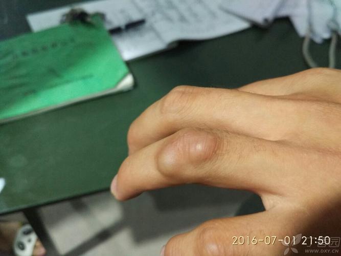 腱鞘囊肿的治疗方法