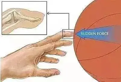 打篮球吃萝卜了怎么快速好（打球时动不动就吃萝卜，怎么应急处理会好得快？）