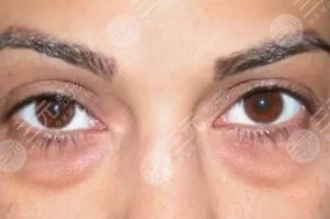 去眼袋手术要多少钱(手术去眼袋多少钱一次)-华海博客