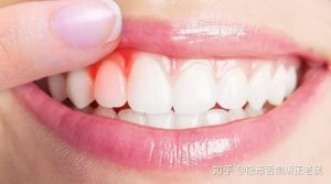 牙龈萎缩怎么治疗(牙龈萎缩怎么治疗吃什么药)-华海博客